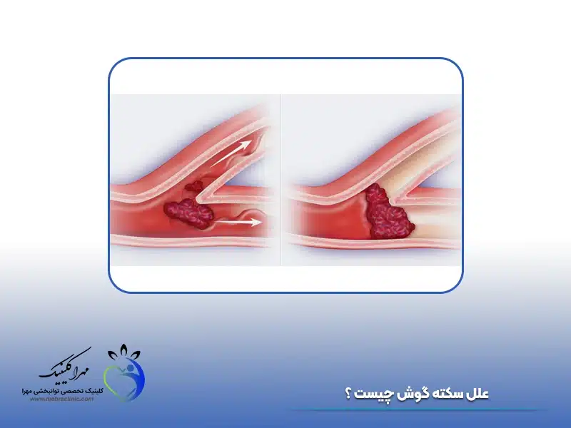 علل سکته گوش چیست ؟