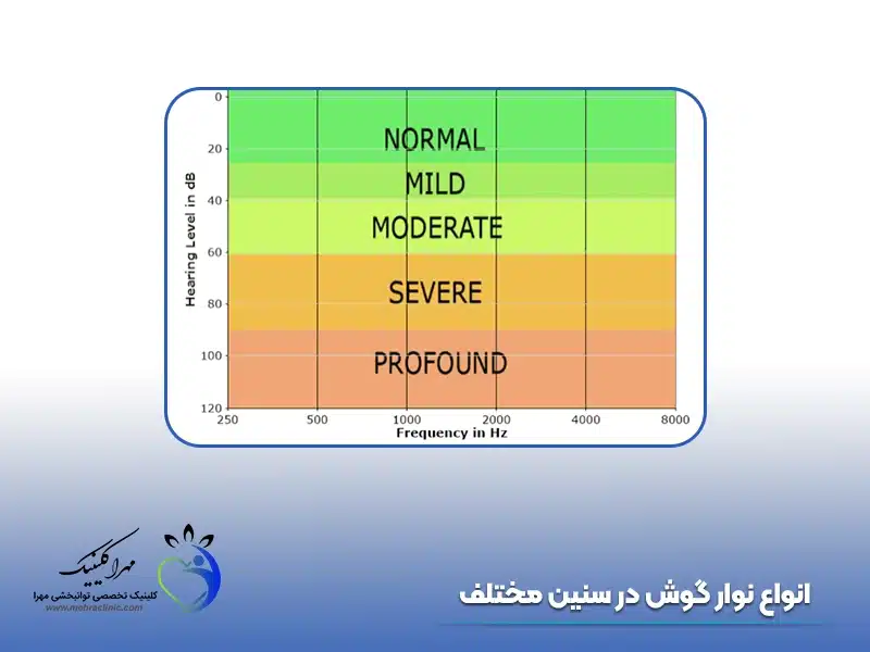 انواع نوار گوش