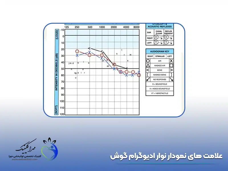 علامت های نمودار نوار ادیوگرام گوش