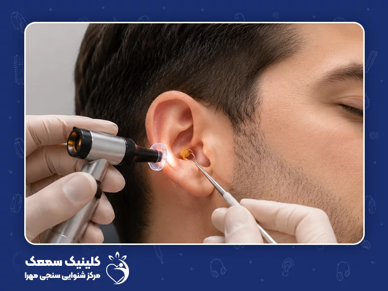 بهترین روش درمان وزوز گوش: 17. حذف جرم گوش