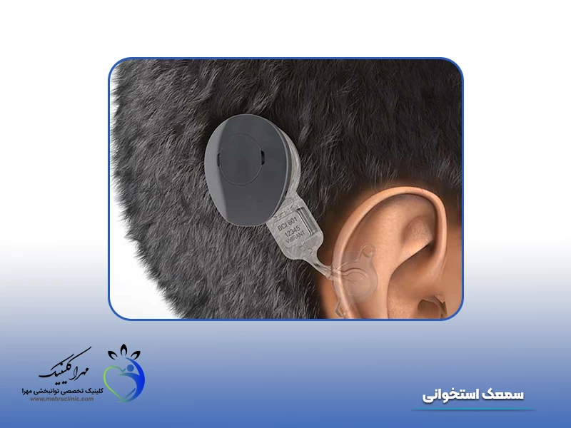 انواع سمعک: 11. سمعک استخوانی
